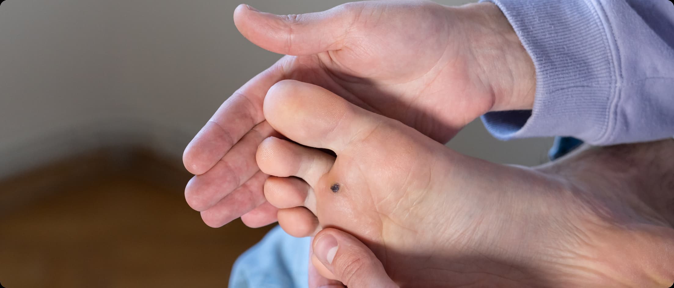Corn vs Wart: What’s the Difference?