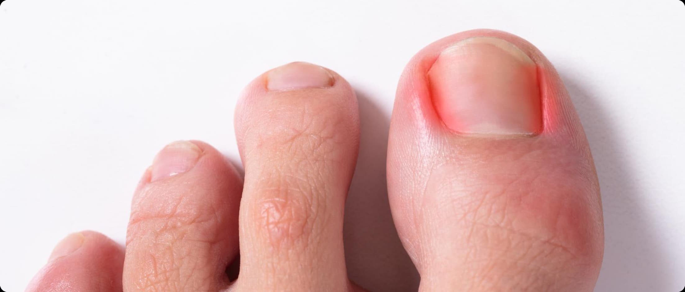 Antiobiotics Haven’t Fixed Your Ingrown Toenail?
