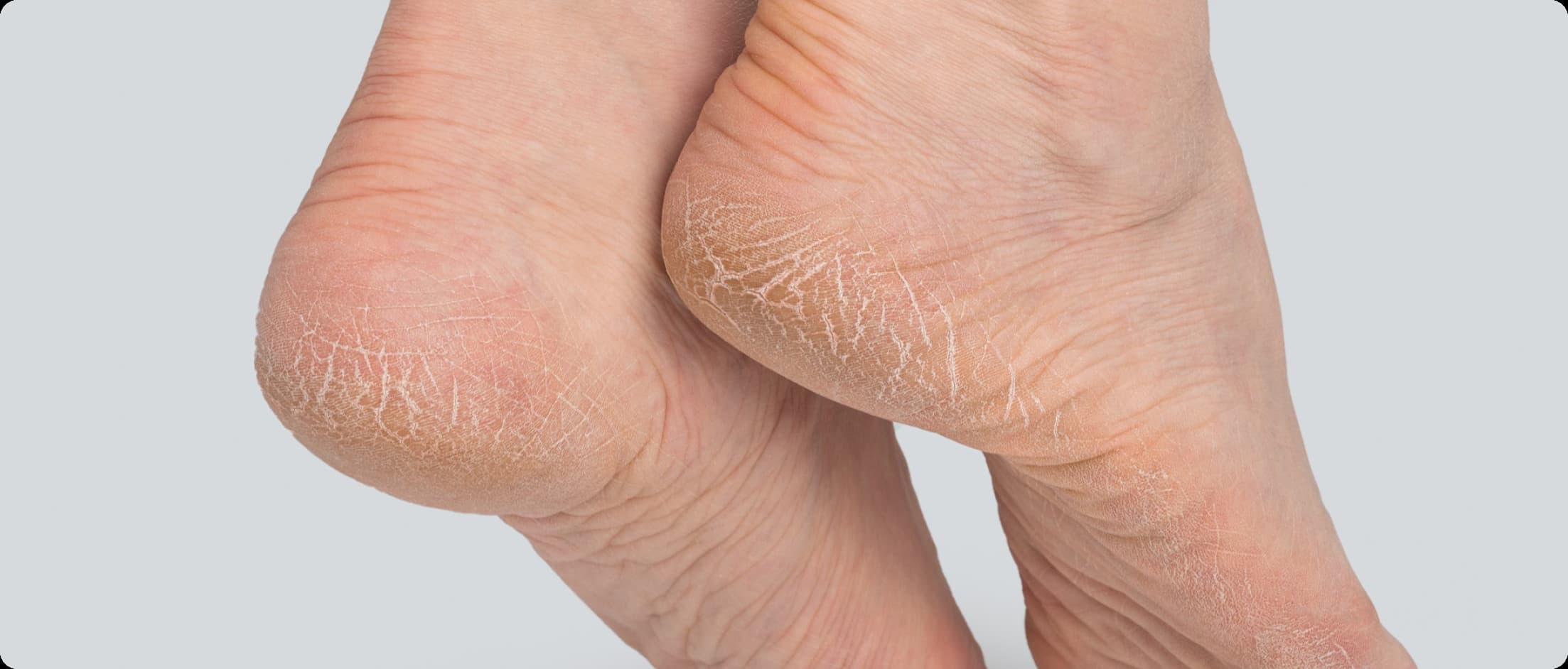 Cracked Heels (Dry, Split Heels)